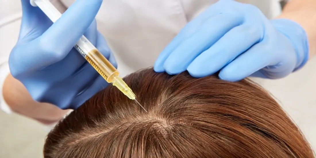 A PRP hair restoration treatment being administered to the scalp